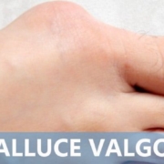 Alluce valgo: sintomi, cause e rimedi