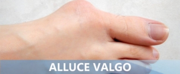 Alluce valgo: sintomi, cause e rimedi