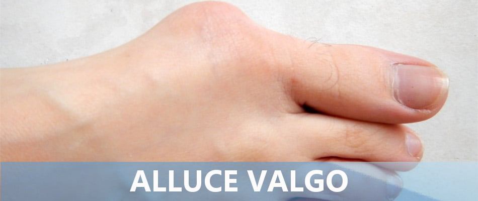 Alluce valgo: sintomi, cause e rimedi