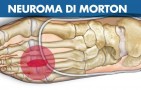 Neuroma di Morton: sintomi, cause e cura