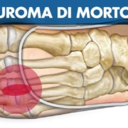 Neuroma di Morton: sintomi, cause e cura