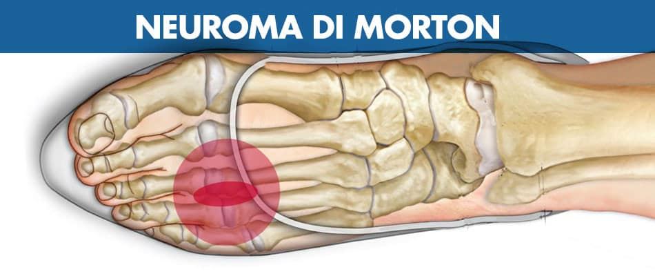 neuroma di morton.