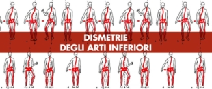 Dismetrie degli arti inferiori