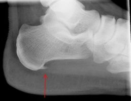 Radiografia spina calcaneare tallone