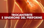 Trocanterite e sindrome del piriforme