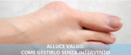 Alluce valgo senza intervento: come gestire la patologia