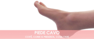 piede cavo: sintomi, cause, rimedi