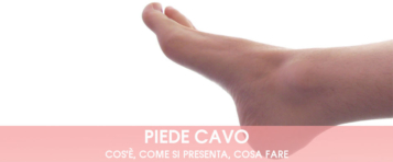 piede cavo: sintomi, cause, rimedi