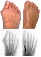 Cura dell'alluce valgo - foto del piede confrontata con radiografia, prima e dopo intervento