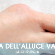 Cura dell'alluce valgo con chirurgia