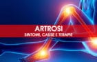 Artrosi: sintomi, cause e terapie