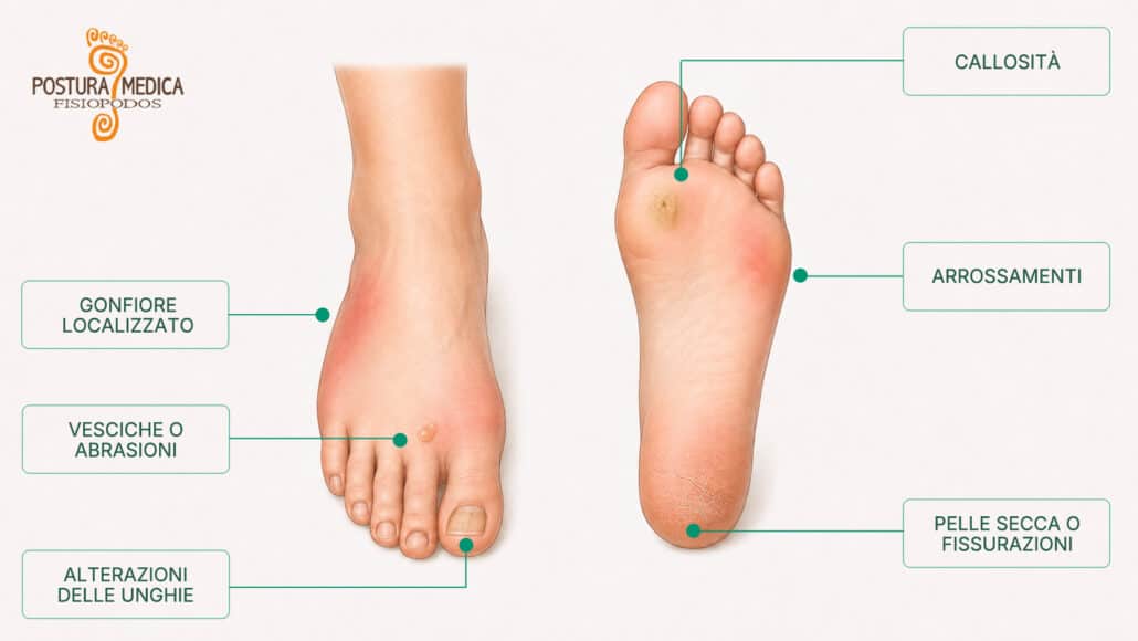 Segnali da controllare nel piede diabetico, tra cui arrossamenti, callosità, vesciche, fissurazioni e gonfiore